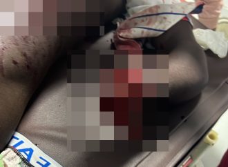 Hombre le corta  brazo a otro durante riña con machete en Higüey