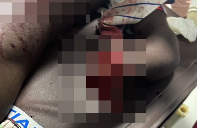 Hombre le corta  brazo a otro durante riña con machete en Higüey