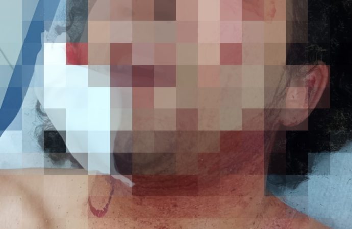 Hombre muere calcinado y otro resulta herido en accidente en la carretera Otra Banda–Verón