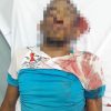 Muere hombre tras sufrir descarga eléctrica y caer de poste en Higüey