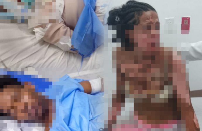 Mujer y su pareja resultan con quemaduras tras incendio de vivienda en Higüey