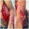 Hombre resulta herido de arma blanca tras agresión de su pareja en Villa Cerro, Higüey