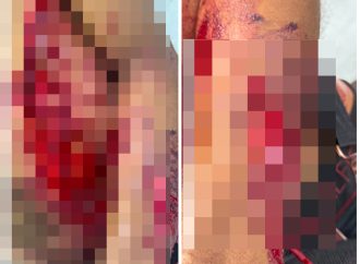 Hombre resulta herido de arma blanca tras agresión de su pareja en Villa Cerro, Higüey